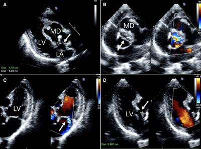 Case Report: Myocardial dissection caused by ruptured sinus of Valsalva aneurysm in association with a bicuspid aortic valve